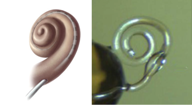 Cochlear Implant