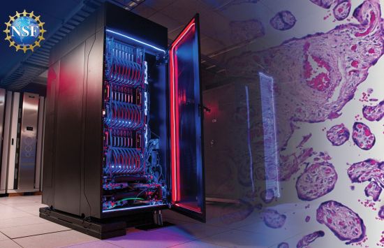 Graphic showcasing cosmos supercomputer and a histology image of preeclampsia placenta