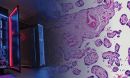 image of preeclampsia placenta