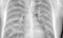 x-ray
