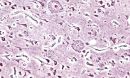 Microscopic image of senile plaques seen in the cerebral cortex of a person with Alzheimer's