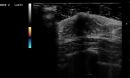 ultrasound image of breast tissue