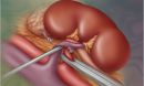 A depiction of the kidney as seen in a live donor transplant.