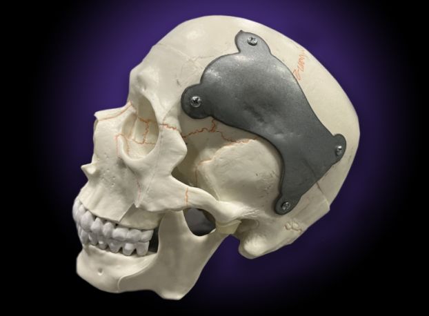 A human skull model with a large plate screwed to its left side.