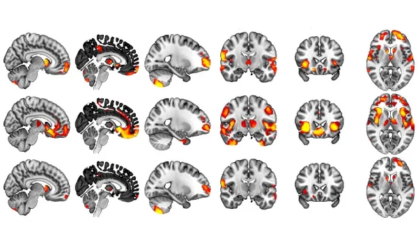 Socioeconomic status and the brain