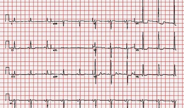 vitals on graph