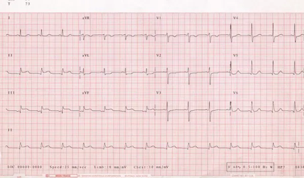 graph of heartbeats