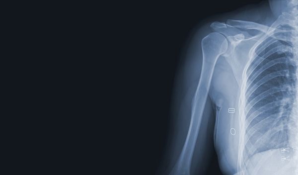 xray of human chest