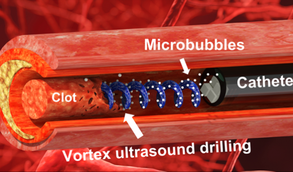 Researchers have developed a new tool that uses "vortex ultrasound" to break down blood clots in the brain.
