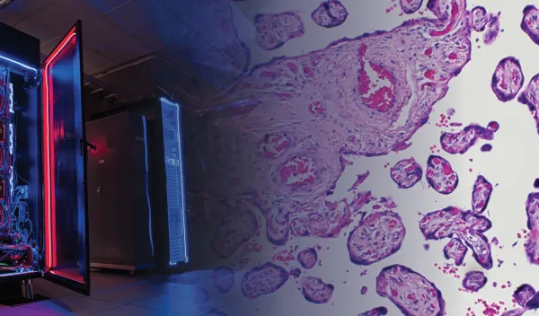 image of preeclampsia placenta