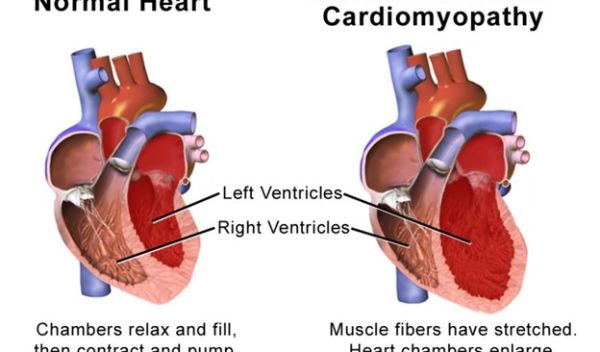 3D model heart