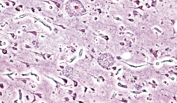 Microscopic image of senile plaques seen in the cerebral cortex of a person with Alzheimer's