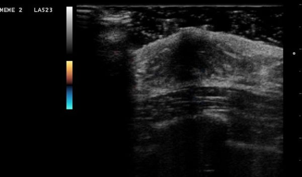 ultrasound image of breast tissue