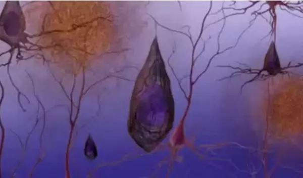 Alzheimer's treatment screening