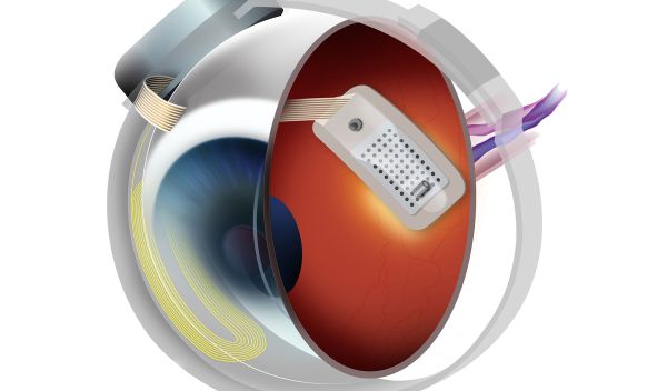 Illustration of an eyeball with retinal implant