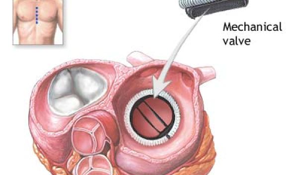 Illustration shows circular mechanical valve inside heart.