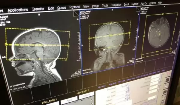 scans of infants' brains