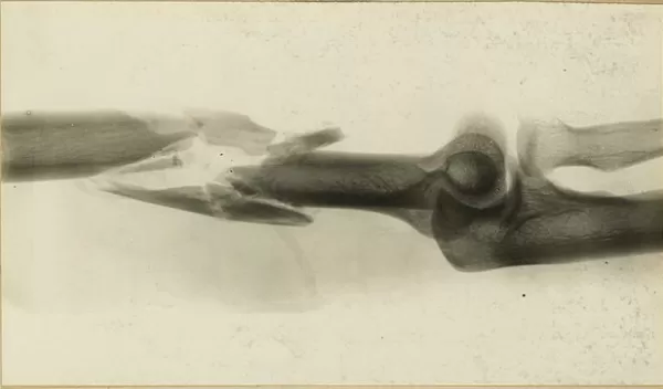 an x-ray of a broken bone