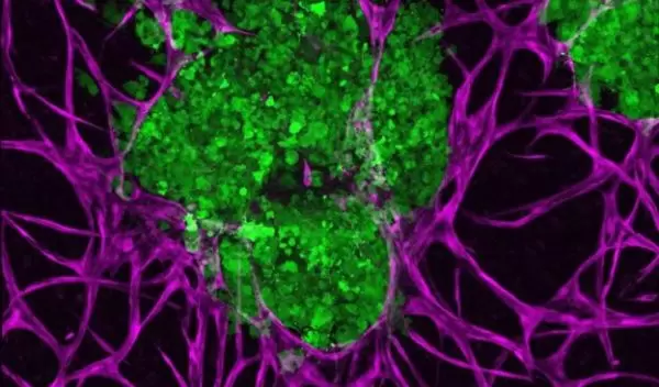 3D bioprinted breast cancer tumors (green)