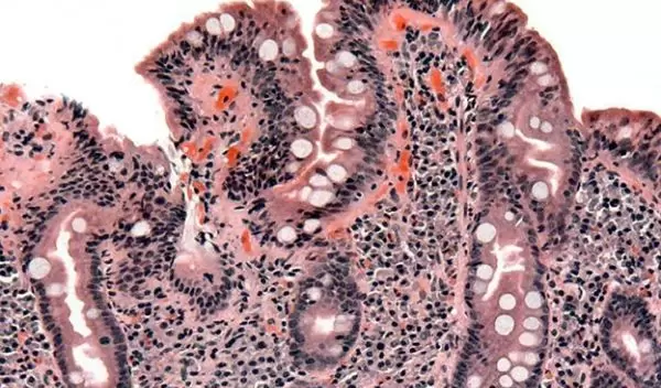 In a study of infants, changes in the gut microbiome preceded the onset of celiac disease.