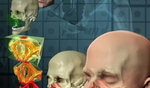 facial reconstruction through the use of topological optimization.