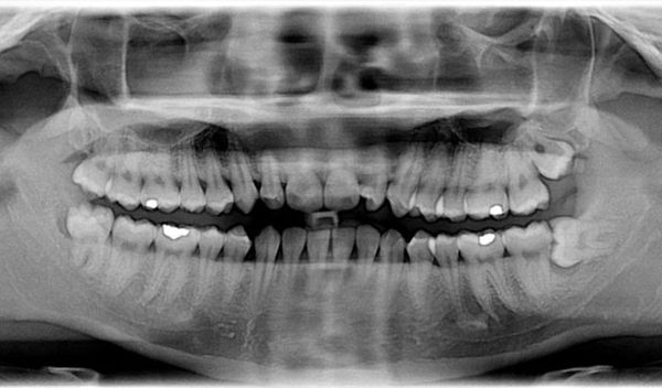 x-ray of teeth