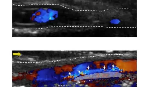 Researchers developed particles that target blood clots and visualize their structures