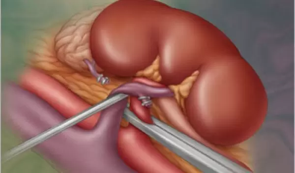 A depiction of the kidney as seen in a live donor transplant.