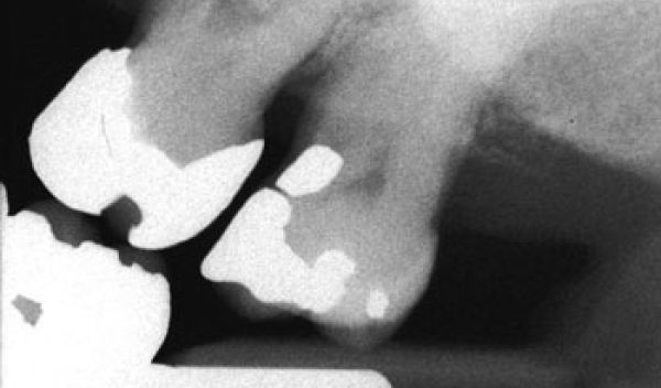 X-ray image of teeth at one angle