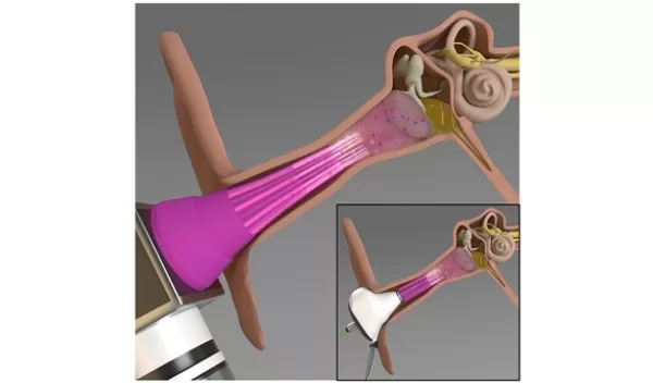 An illustration of the potential new treatment for middle ear infections.