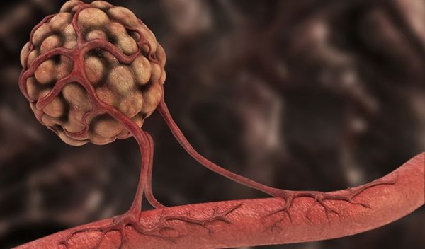 tumor growth
