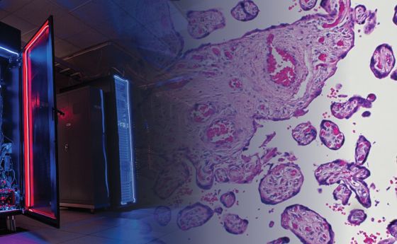 image of preeclampsia placenta