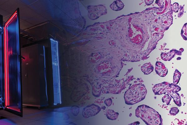 image of preeclampsia placenta